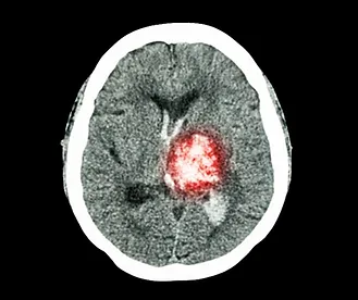 Hemorrhagic Stroke
