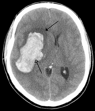 brain scan with an abnormal lump