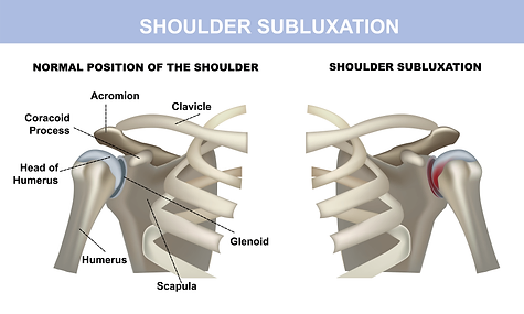 shoulder subluxation