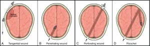Common patterns of penetrating brain injury.