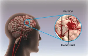 TBI Diagram showing bleeding and blood vessels
