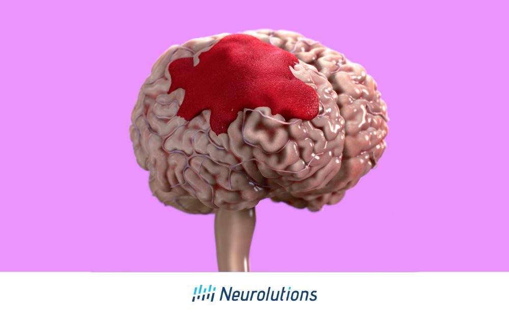 Brain Bleed | Neurolutions